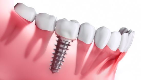 what-are-the-types-of-dental-implants-turkey