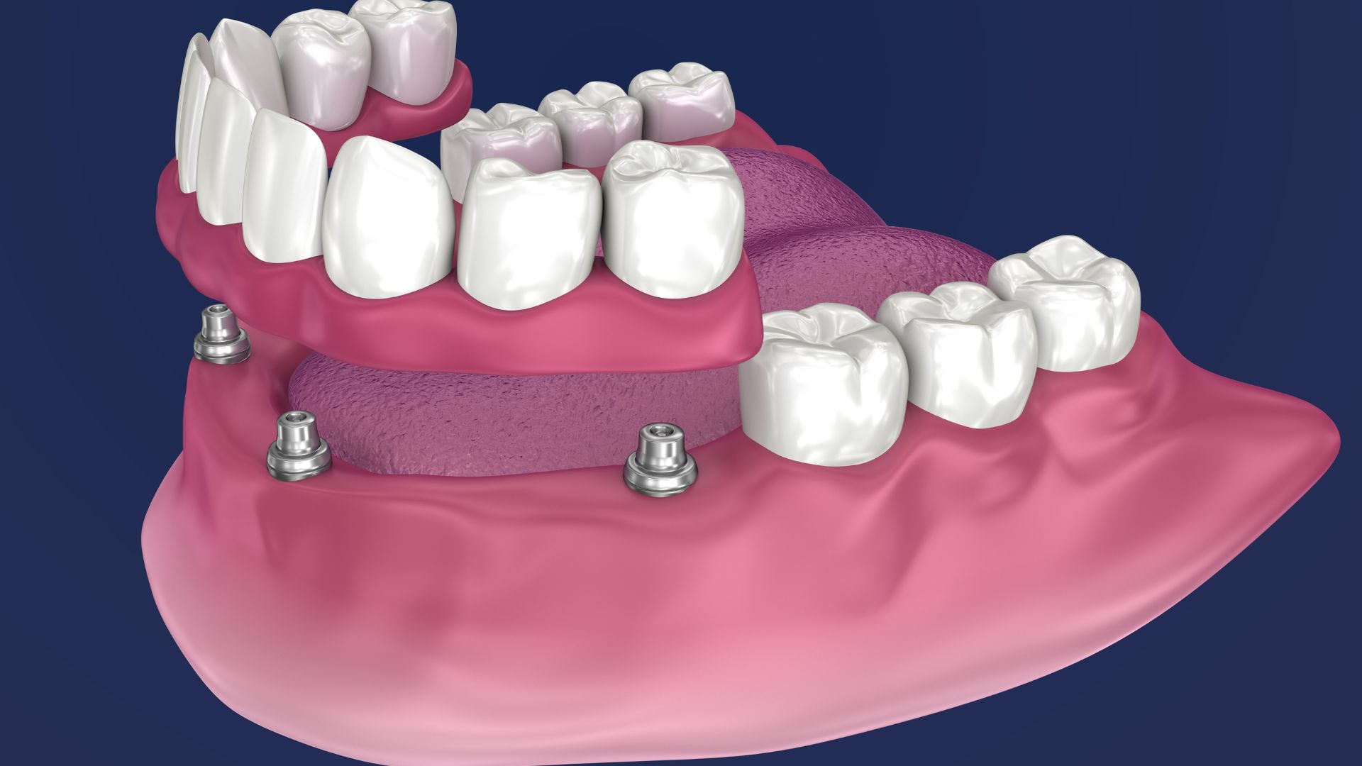 What is the Difference Between Implant Teeth and All On Four and All On Six Treatments? in Turkey, Istanbul