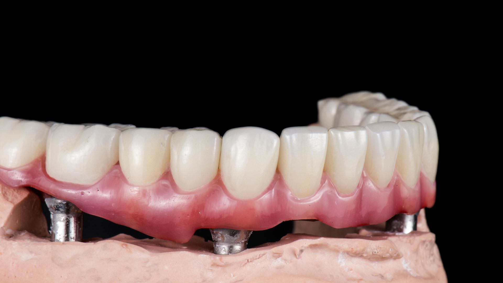 The Main Differences between All on 4 and Traditional Dental Implants in Turkey, Istanbul