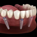 dental implant istanbul