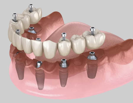 dental implants Turkey