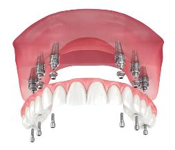 What are the advantages of all on 6 dental implants? in Turkey, Istanbul