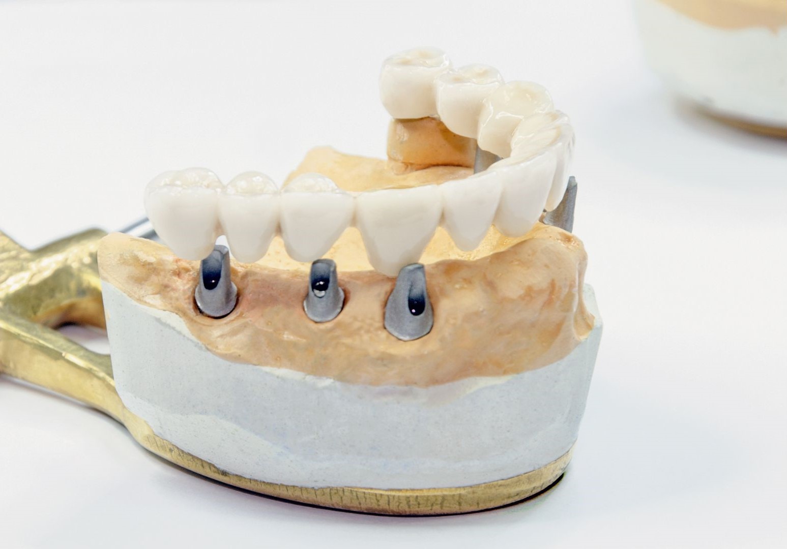 What is the Difference Between Implant Teeth and All On Four and All On Six Treatments? in Turkey, Istanbul