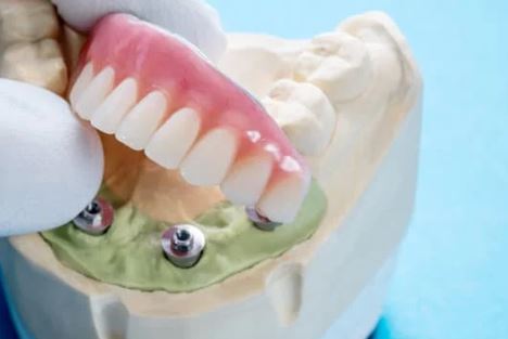 Which situations require the all-on-four dental implant procedure? in Turkey, Istanbul