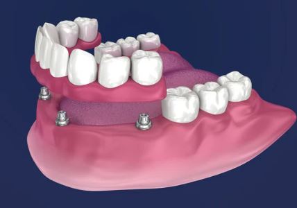 how-much-do-dental-implants-cost-in-turkey