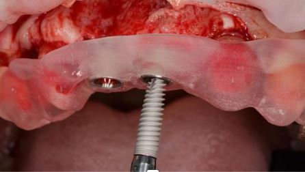 What are the advantages of all on 6 dental implants? in Turkey, Istanbul