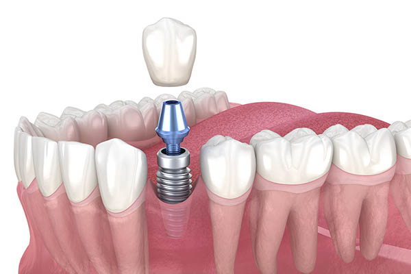 What is an dental implant? in Turkey, Istanbul