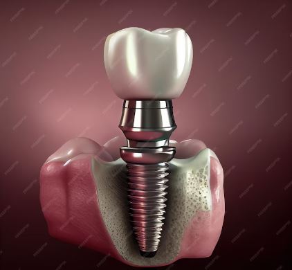 what-are-the-best-dental-implant-brands-turkey