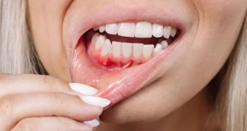 The hole in gums: causes, symptoms, diagnosis, prevention and treatment in Turkey, Istanbul Dental Clinic