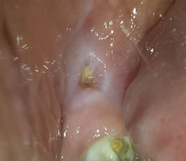 Why do I have holes in my gum? in Turkey, Istanbul Dental Clinic