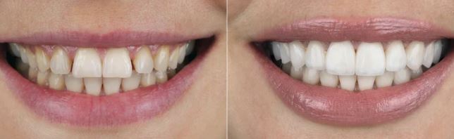what-are-the-advantages-of-laminated-dental-veneers-turkey