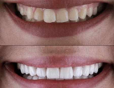 dental implants Turkey