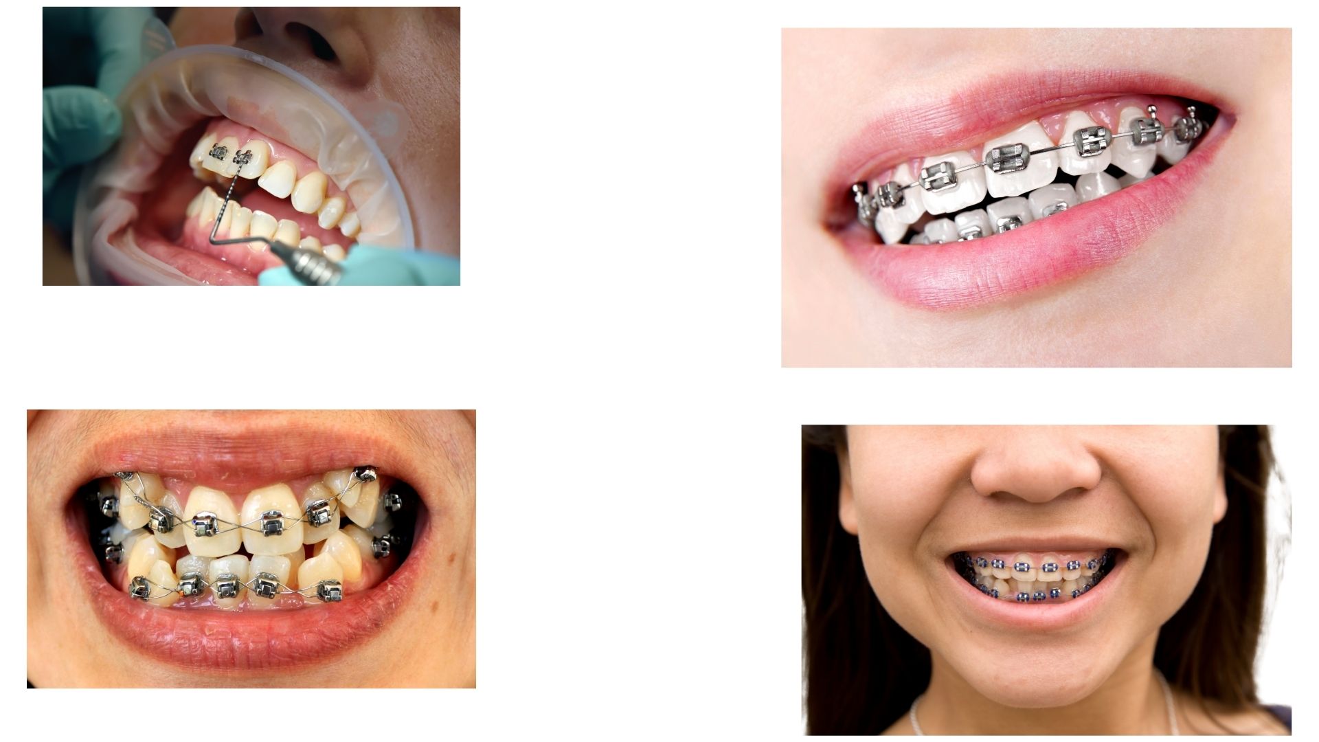 Orthodontic treatment