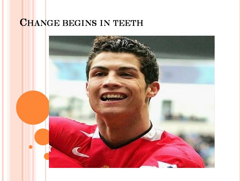 Ronaldo teeth elimination of differences in the size of the teeth