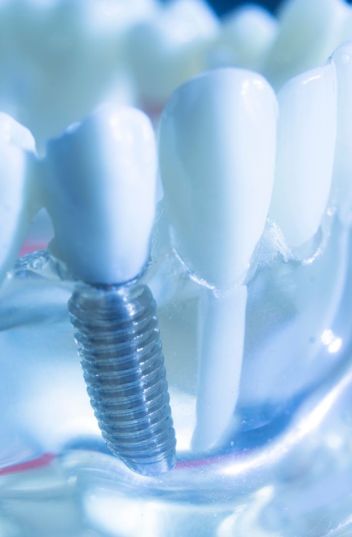 What is Seamless Implant Treatment? in Turkey, Istanbul