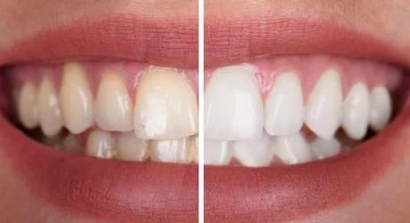 how-many-teeth-whitening-sessions-do-i-need-turkey