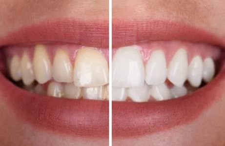 How many teeth whitening sessions do you need? in Turkey Istanbul Dental Clinic