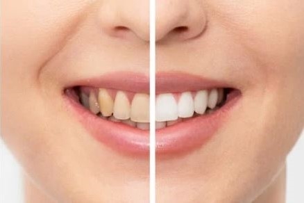 how-to-get-rid-of-yellow-stains-on-teeth-and-whiten-yellow-teeth