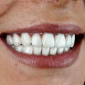 dental implant istanbul